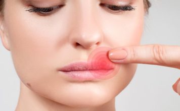 How to Get Rid of a Cold Sore—and Prevent It From Coming Back