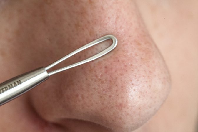 How to Get Rid of Those Stubborn Blackheads on Your Nose